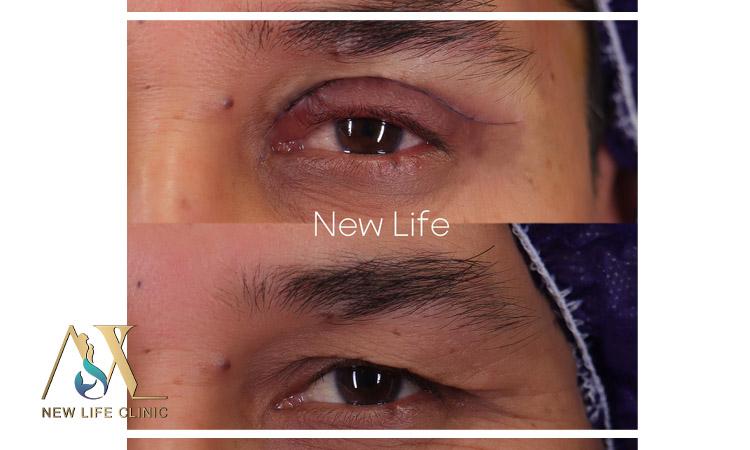 بلفاروپلاستی پلک بالا