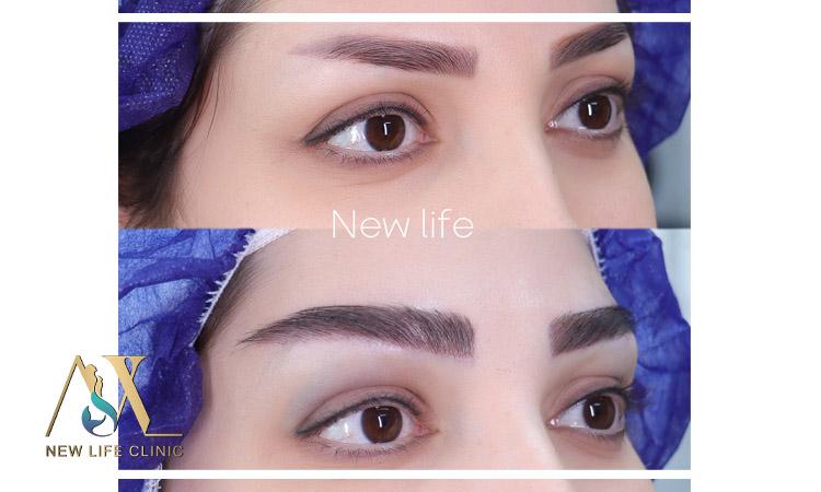 بلفاروپلاستی پلک بالا