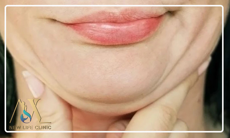 چرا با وجود لاغری هنوز غبغب دارم؟