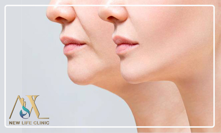 چرا با وجود لاغری هنوز غبغب دارم؟