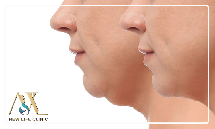 مقایسه لیپو ساکشن غبغب با سایر روش های کاهش چربی صورت