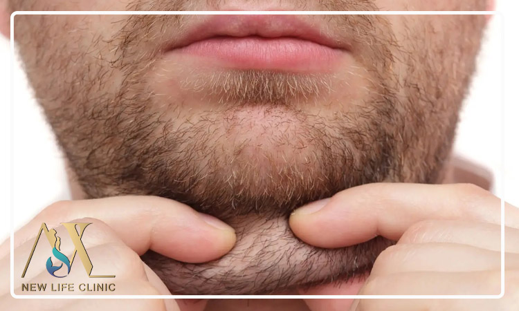 مقایسه لیپو ساکشن غبغب با سایر روش های کاهش چربی صورت