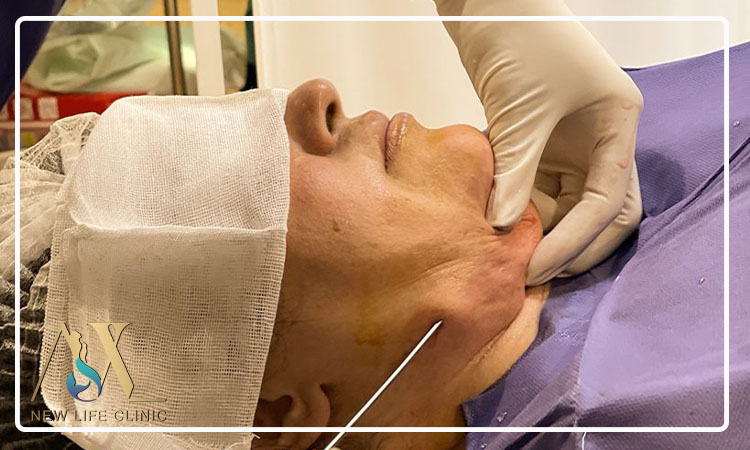 مقایسه لیپو ساکشن غبغب با سایر روش های کاهش چربی صورت