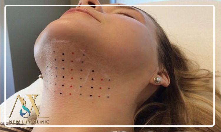 آیا لیپو ساکشن غبغب جای زخم باقی می گذارد؟