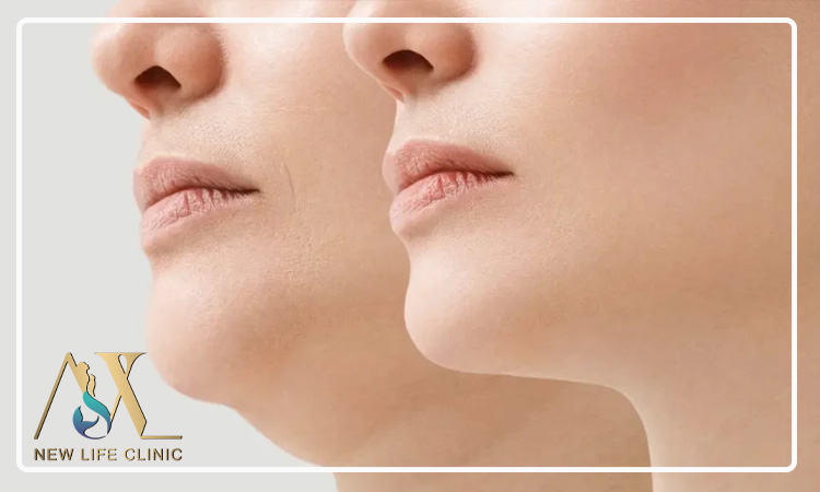 آیا لیپو ساکشن غبغب جای زخم باقی می گذارد؟