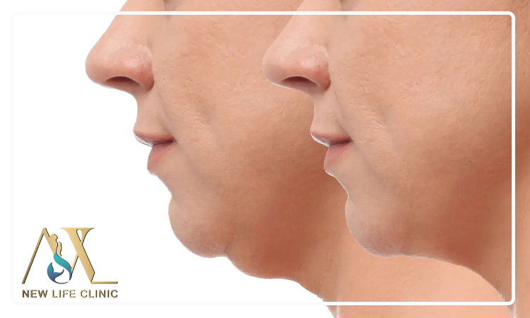 مدت دوران نقاهت لیپو فیس غبغب چقدر است؟