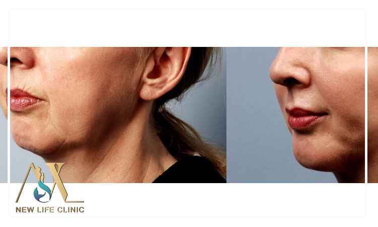 نحوه خوابیدن بعد از تزریق چربی صورت