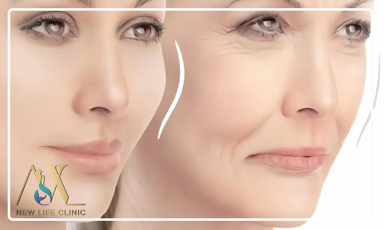 اثرات بلندمدت لیپو فیس بر زیبایی صورت