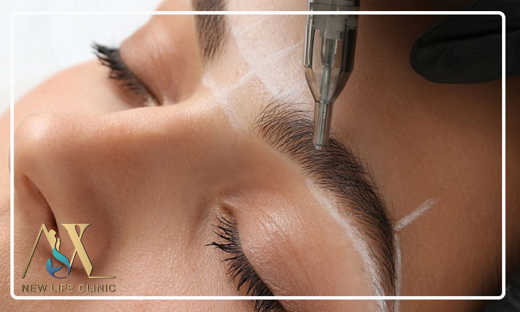 مزیت میکرو کاشت برای پر کردن ناحیه های خالی ابرو