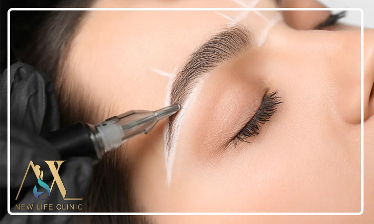 مزیت میکرو کاشت برای پر کردن ناحیه های خالی ابرو