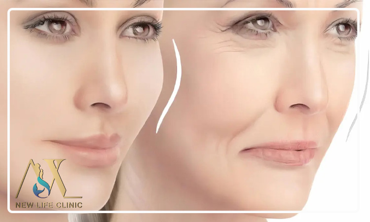 چه افرادی بهترین کاندید انجام لیپو فیس هستند؟