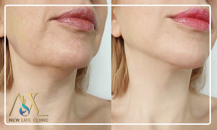 دوره نقاهت لیپو ساکشن غبغب چقدر طول می کشد؟