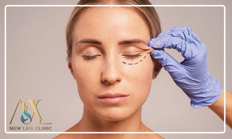 چگونه جای زخم بعد از بلفاروپلاستی را کاهش دهیم؟