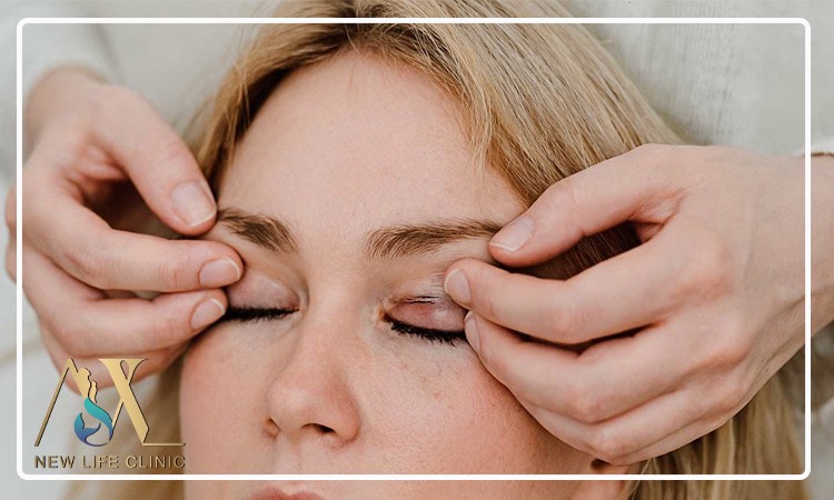 چگونه جای زخم بعد از بلفاروپلاستی را کاهش دهیم؟