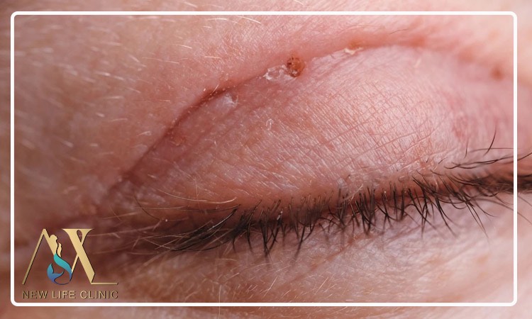 چگونه جای زخم بعد از بلفاروپلاستی را کاهش دهیم؟