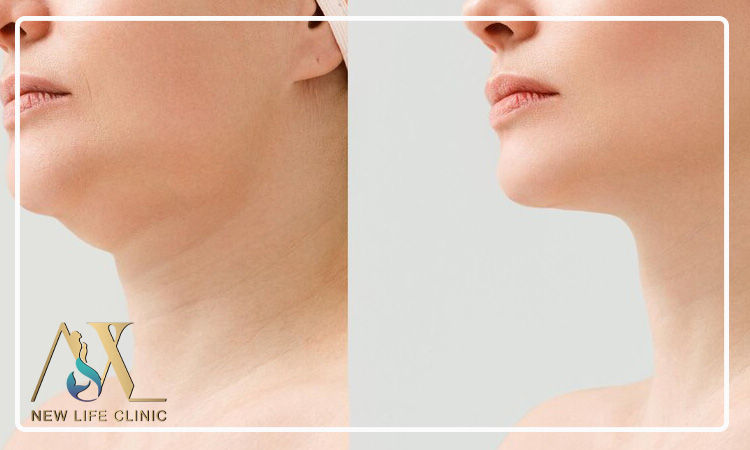 چطور جراح مناسب برای لیپو ساکشن غبغب انتخاب کنیم؟