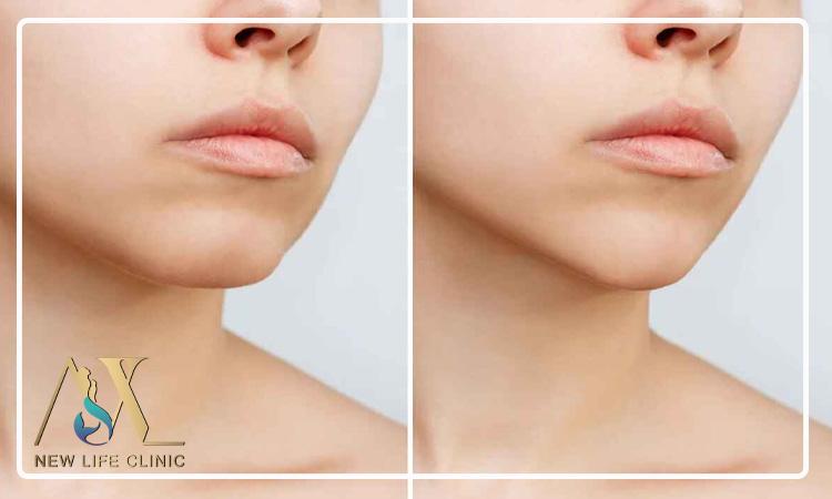 چطور جراح مناسب برای لیپو ساکشن غبغب انتخاب کنیم؟