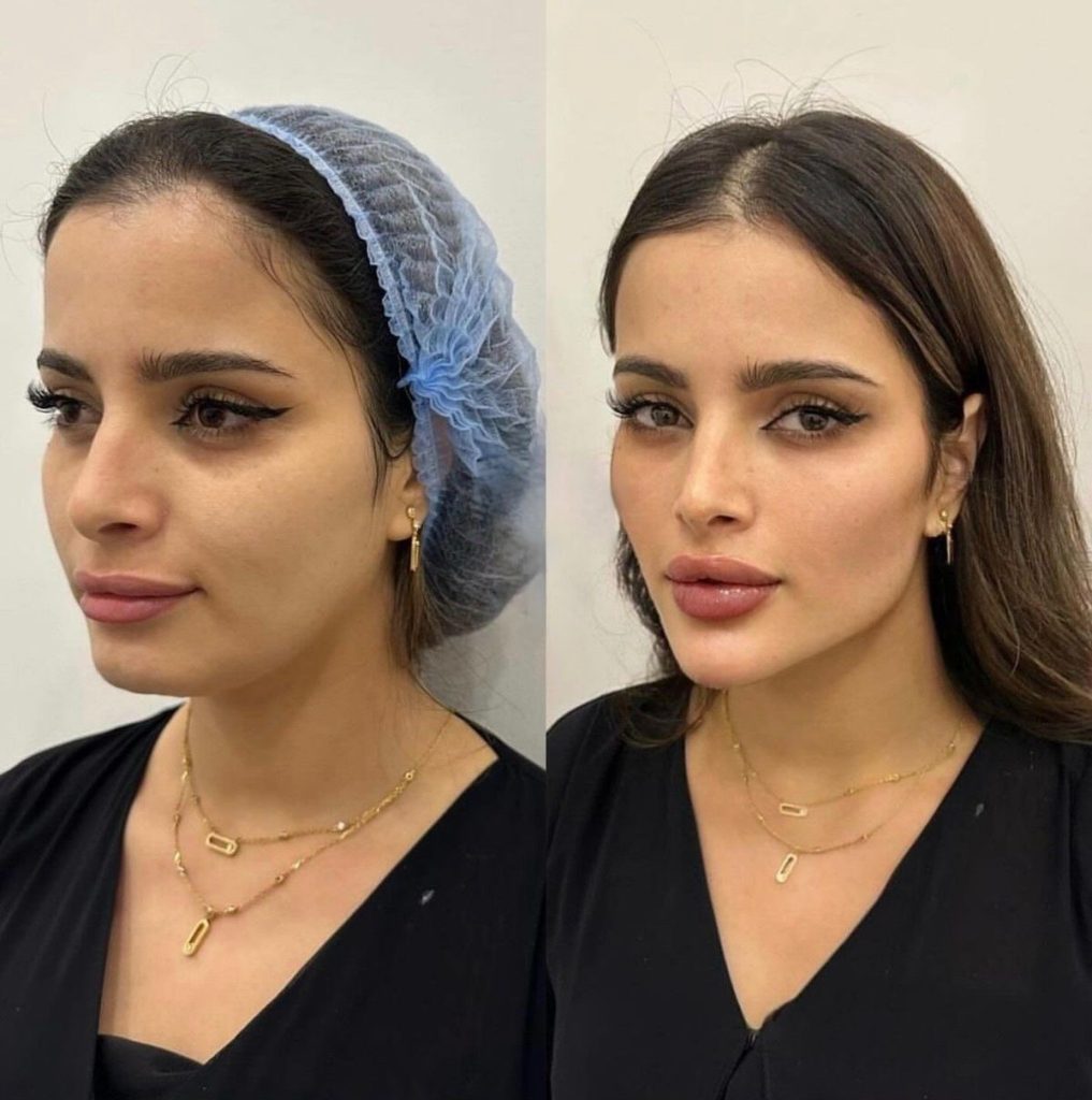 نکات مهم قبل و بعد از کانتورینگ صورت