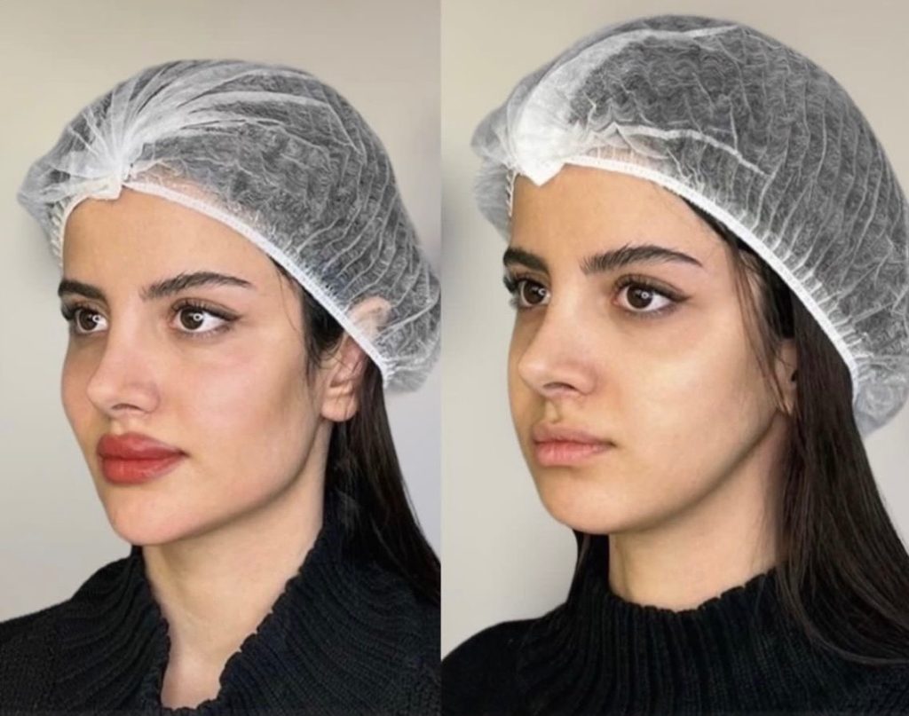 نکات مهم قبل و بعد از کانتورینگ صورت
نکات مهم قبل و بعد از کانتورینگ صورت