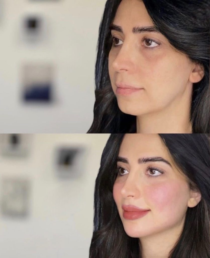 نکات مهم قبل و بعد از کانتورینگ صورت