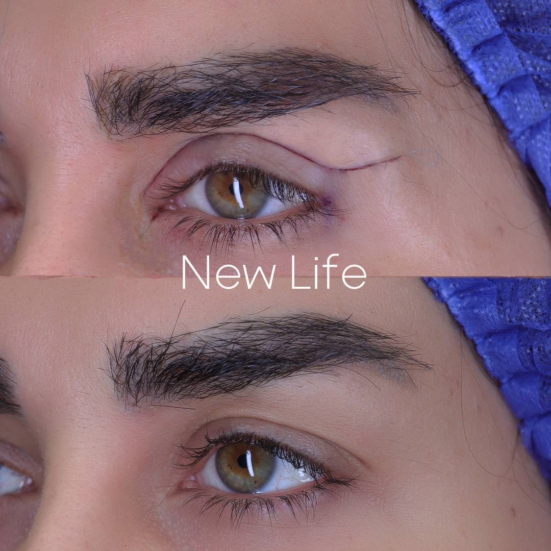 blepharoplasty-with-sterile-cap (9)