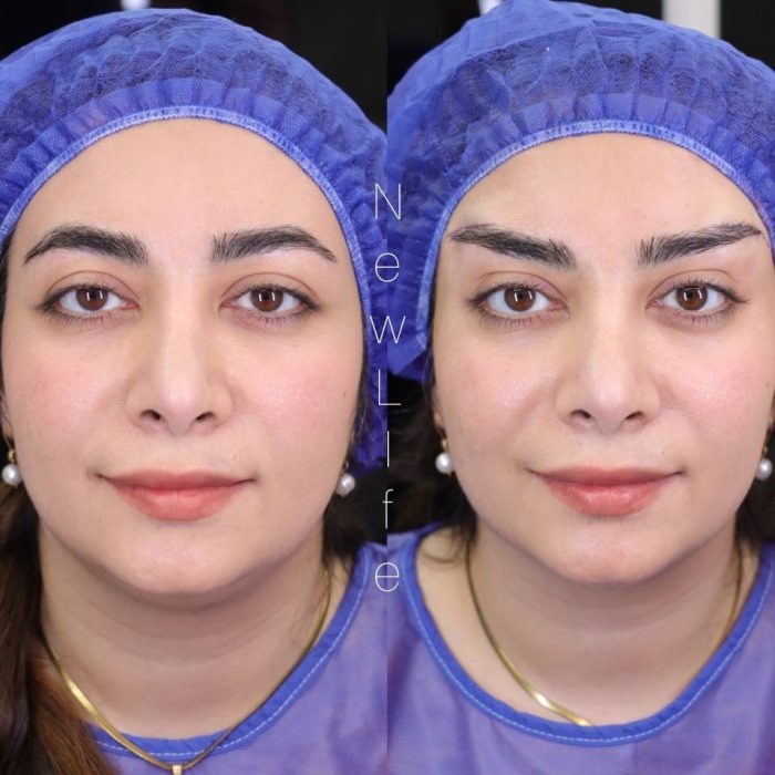 متخصص زیبایی در حال انجام لیفت دایرکت