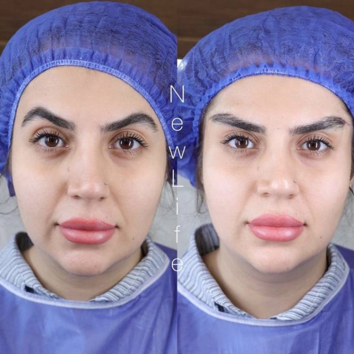 جوانسازی صورت با عمل دایرکت ابرو