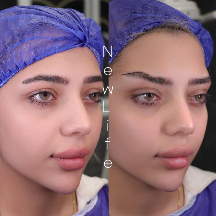 کلینیک نیولایف مرکز تخصصی لیفت ابرو