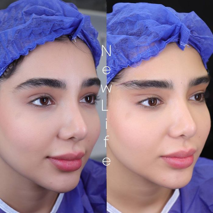 شادابی چهره با لیفت مستقیم ابرو